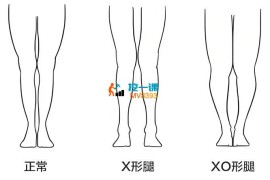 一介粗人《腿型矫正课》