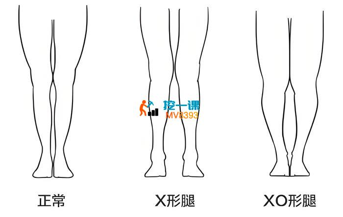 一介粗人《腿型矫正课》_封面图.jpeg